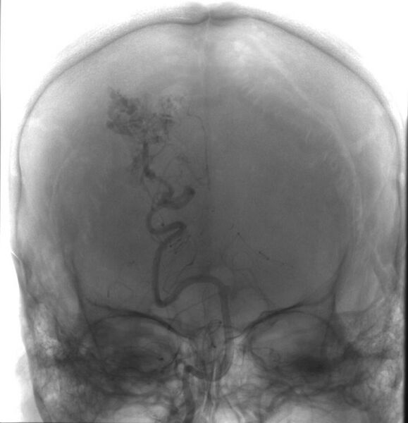 File:Cerebral arteriovenous malformation (Radiopaedia 10989-11408 G 1).jpg