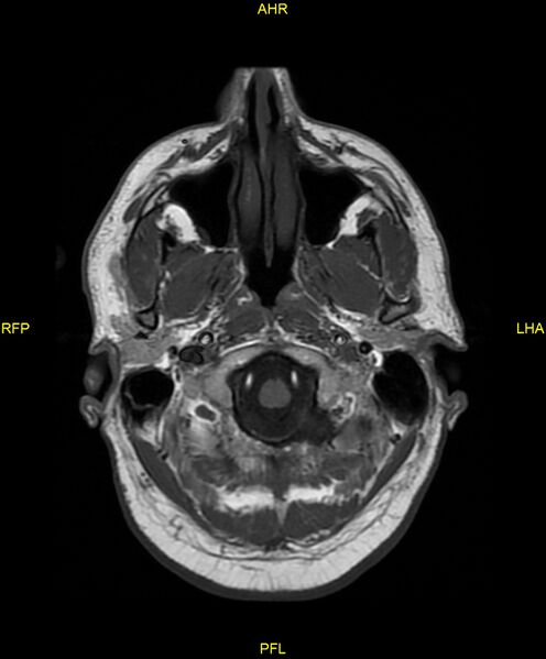 File:Cerebral autosomal dominant arteriopathy with subcortical infarcts and leukoencephalopathy (CADASIL) (Radiopaedia 86108-102054 Axial T1 3).jpg