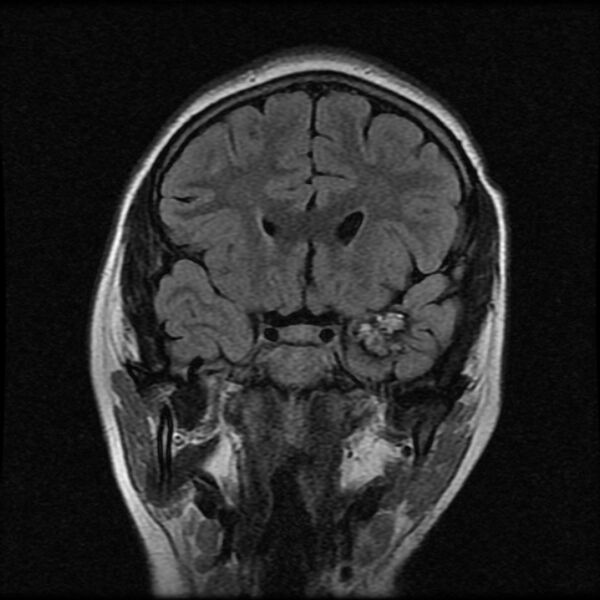File:Cerebral cavernous malformation (Radiopaedia 44301-47942 Coronal FLAIR 5).jpg