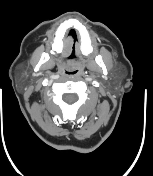 File:Cerebral dural venous sinus thrombosis (Radiopaedia 86514-102576 A 13).jpg