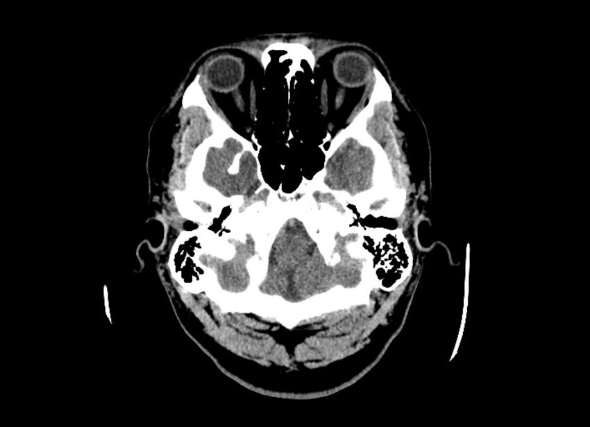 Cerebral edema (Radiopaedia 82519-96661 Axial non-contrast 46).jpg