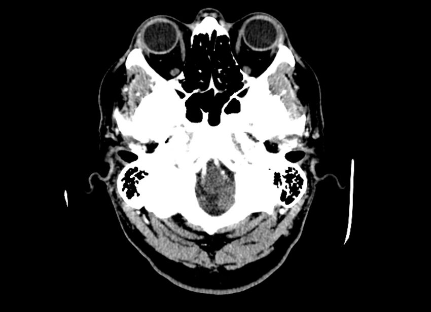 Cerebral edema (Radiopaedia 82519-96661 B 50).jpg