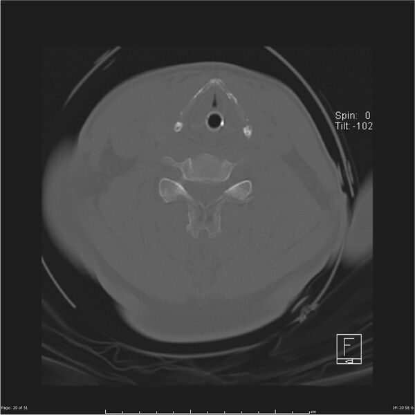 File:Cerebral hemorrhagic contusions and cervical spine fractures (Radiopaedia 32865-33841 C 20).jpg
