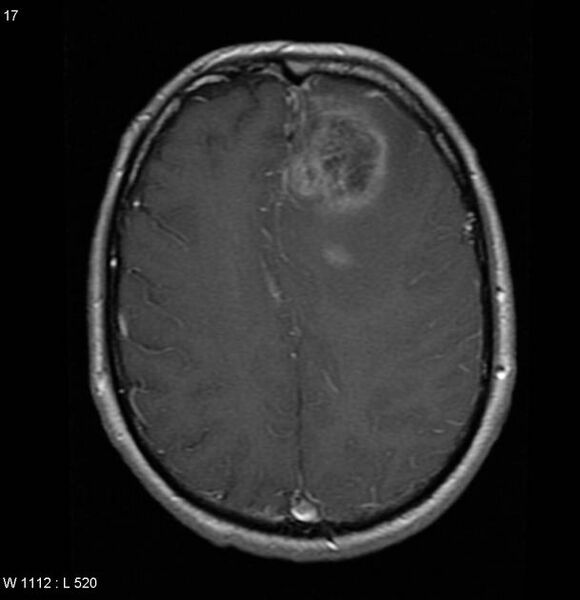 File:Cerebral metastases - renal cell carcinoma (Radiopaedia 5510-7246 Axial T1 C+ 3).jpg