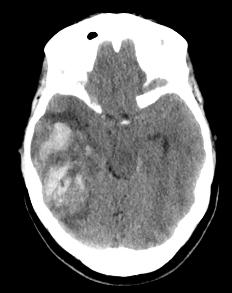 File:Cerebral venous infarct related to dural venous sinus thromboses (Radiopaedia 35292-36803 AXIAL THICK 10).png