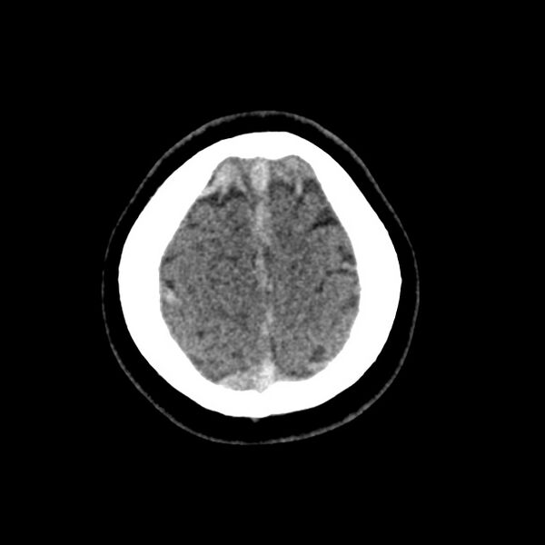 File:Cerebral venous sinus thrombosis (Radiopaedia 59224-66551 Axial non-contrast 50).jpg