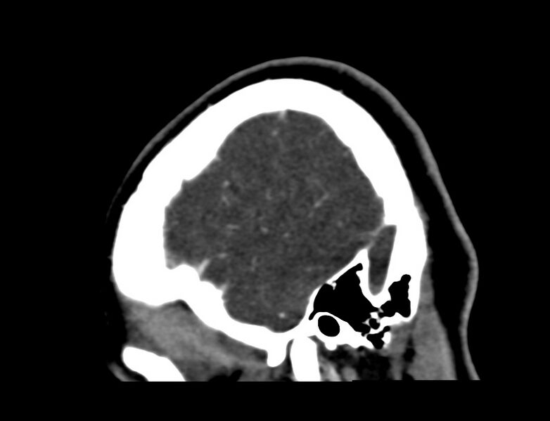 File:Cerebral venous sinus thrombosis (Radiopaedia 59224-66646 Sagittal C+ delayed 63).jpg