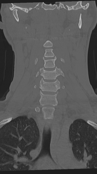 File:Cervical intercalary bone (Radiopaedia 35211-36748 Coronal bone window 30).png