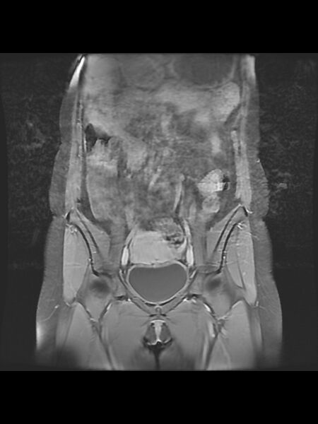 File:Cesarean section scar endometrioma (Radiopaedia 56569-63297 Coronal STIR 12).jpg