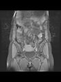 Cesarean section scar endometrioma (Radiopaedia 56569-63297 Coronal STIR 12).jpg
