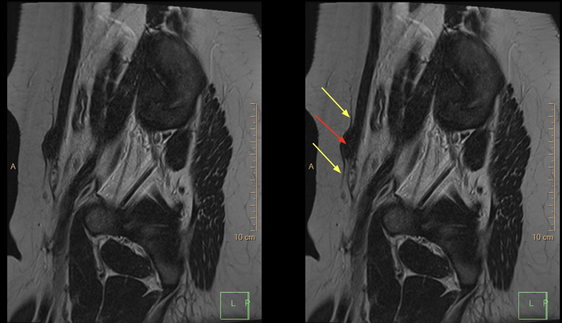 File:Cesarian scar endometriosis (Radiopaedia 68495-78306 D 3).png