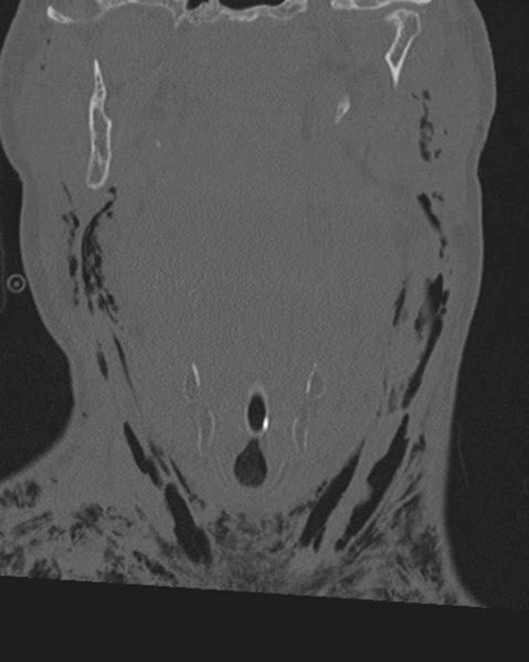 File:Chalk stick fracture (Radiopaedia 57948-64928 Coronal bone window 15).png