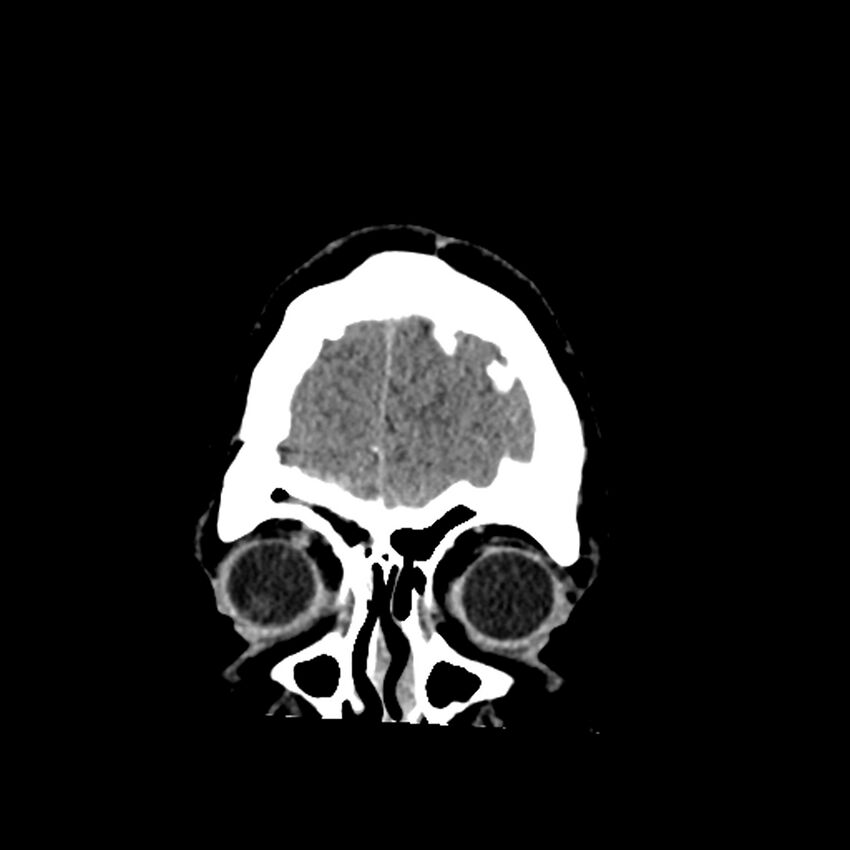 Chiasmatic-hypothalamic juvenile pilocytic astrocytoma (Radiopaedia 78533-91237 Coronal non-contrast 11).jpg