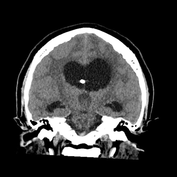 File:Chiasmatic-hypothalamic juvenile pilocytic astrocytoma (Radiopaedia 78533-91237 Coronal non-contrast 38).jpg