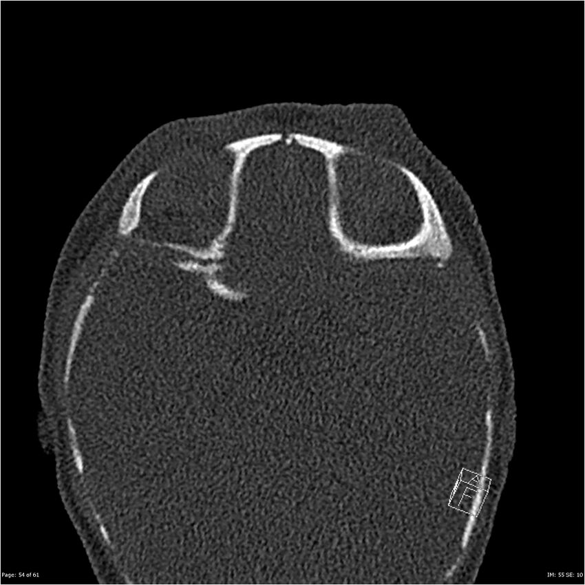 Choanal atresia (Radiopaedia 23492-23579 bone window 54).jpg