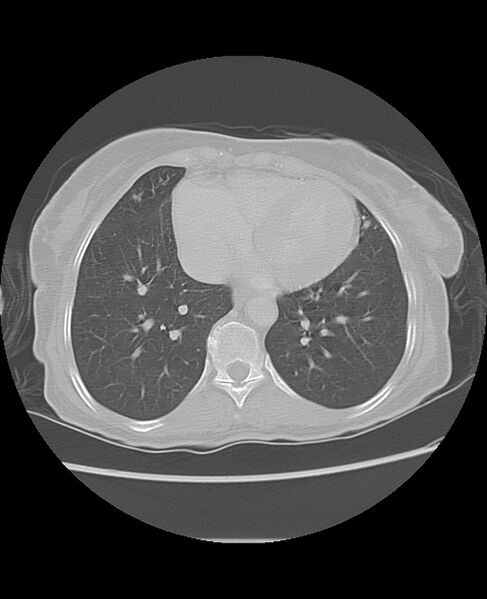 File:Chondrosarcoma (Radiopaedia 79427-92532 Axial lung window 40).jpg