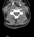 Chordoma (C4 vertebra) (Radiopaedia 47561-52188 Axial non-contrast 27).png