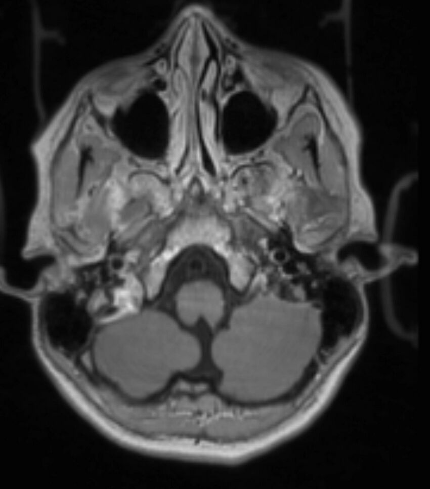 Choroid plexus carcinoma (Radiopaedia 91013-108553 Axial T1 C+ 85).jpg