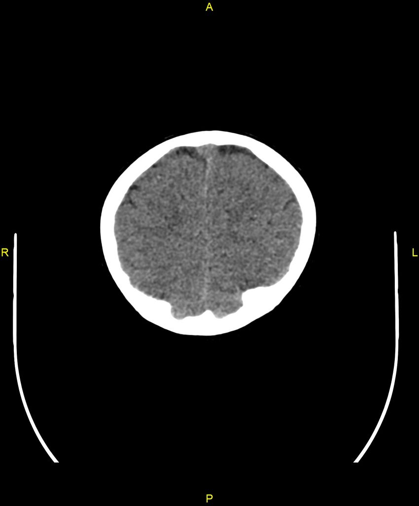 Choroidal fissure cyst (Radiopaedia 89481-106465 Axial non-contrast 103).jpg