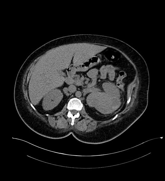 File:Chromophobe renal cell carcinoma (Radiopaedia 84239-99519 Axial non-contrast 68).jpg