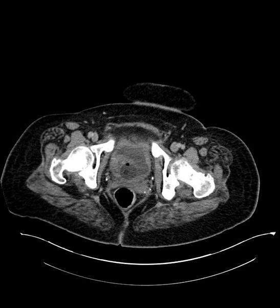 File:Chromophobe renal cell carcinoma (Radiopaedia 84239-99519 E 151).jpg