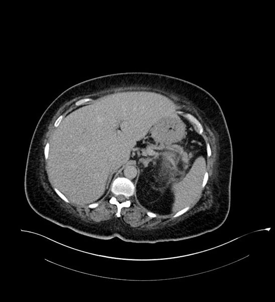 File:Chromophobe renal cell carcinoma (Radiopaedia 84239-99519 E 48).jpg