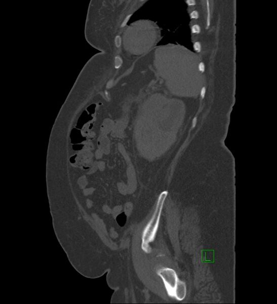 File:Chromophobe renal cell carcinoma (Radiopaedia 84239-99519 Sagittal bone window 21).jpg