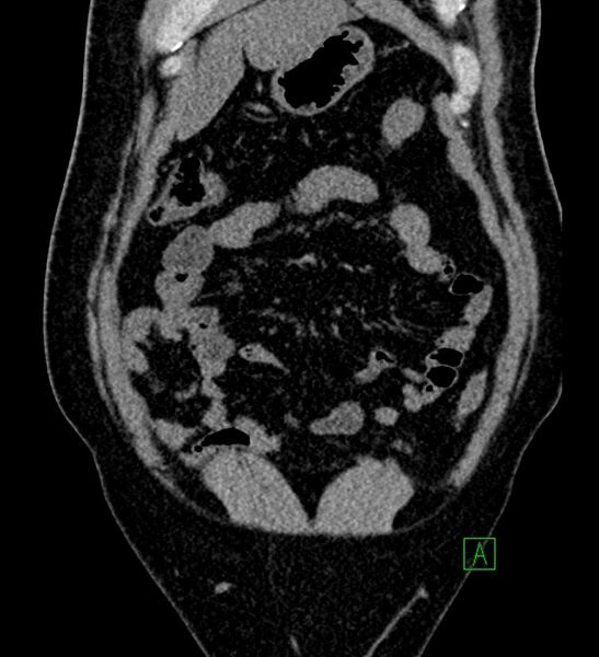 File:Chromophobe renal cell carcinoma (Radiopaedia 84286-99573 Coronal non-contrast 34).jpg