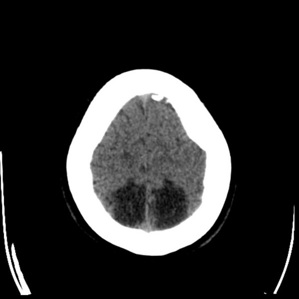 File:Chronic bilateral occipital lobe infarcts (Radiopaedia 31276-31996 Axial non-contrast 37).jpg