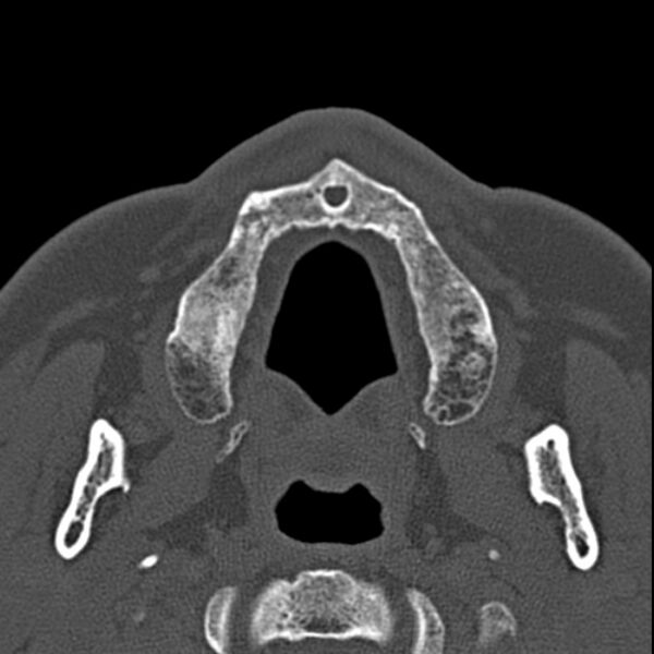 File:Chronic maxillary sinusitis (Radiopaedia 27879-28116 Axial bone window 1).jpg