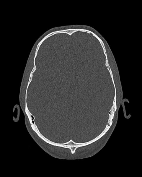 File:Chronic maxillary sinusitis caused by a foreign body (Radiopaedia 58521-65676 Axial bone window 319).jpg