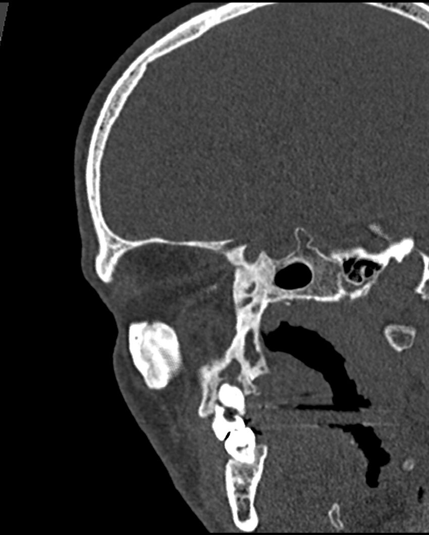 Chronic maxillary sinusitis caused by a foreign body (Radiopaedia 58521-65676 Sagittal bone window 52).jpg