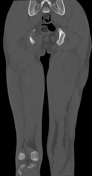 File:Chronic osteomyelitis (with sequestrum) (Radiopaedia 74813-85822 Coronal non-contrast 42).jpg