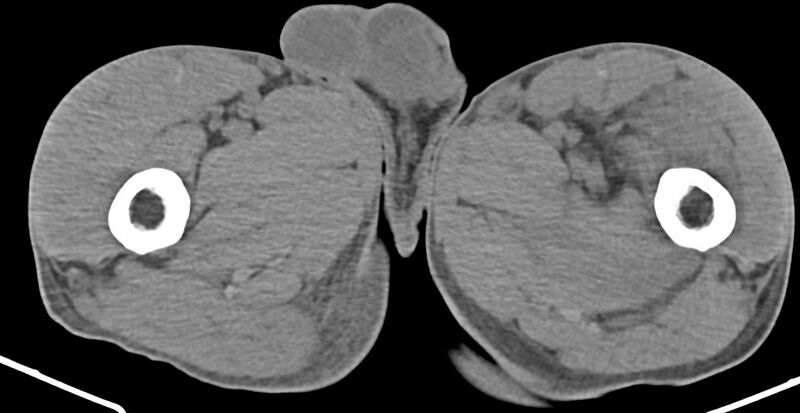 File:Chronic osteomyelitis (with sequestrum) (Radiopaedia 74813-85822 D 66).jpg
