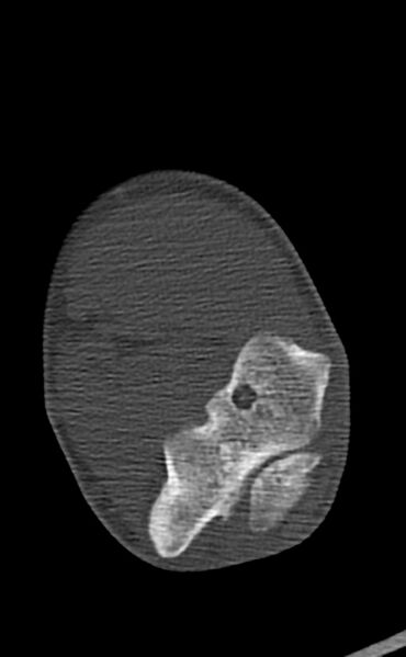 File:Chronic osteomyelitis of the distal humerus (Radiopaedia 78351-90971 Axial 38).jpg