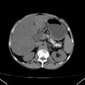 Chronic pancreatitis (Radiopaedia 23132-23172 Axial non-contrast 25).jpg