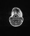 Chronic reactive multifocal osteomyelitis (CRMO) - mandible (Radiopaedia 56405-63069 Axial T1 4).jpg
