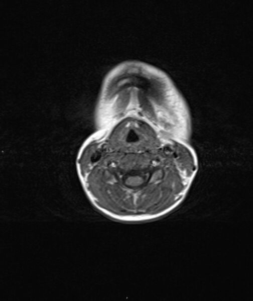 File:Chronic reactive multifocal osteomyelitis (CRMO) - mandible (Radiopaedia 56405-63069 Axial T1 4).jpg