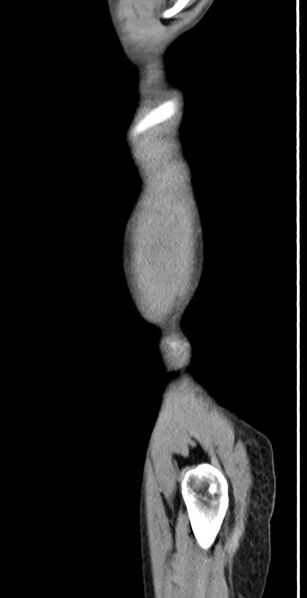 File:Chronic small bowel volvulus (Radiopaedia 75224-86322 C 14).jpg