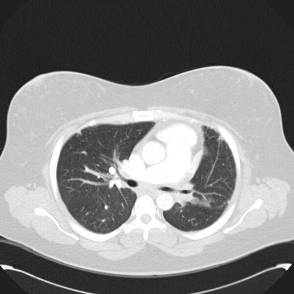 File:Chronic thromboembolic pulmonary hypertension (CTEPH) (Radiopaedia 74597-85531 Axial lung window 22).jpg