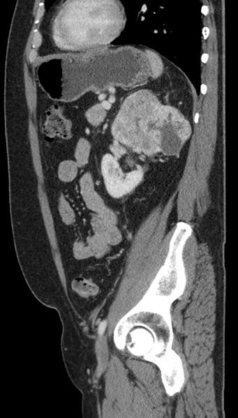 File:Clear cell renal cell carcinoma (Radiopaedia 61449-69393 G 28).jpg