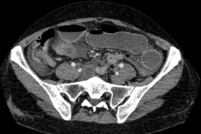 File:Closed loop small bowel obstruction (Radiopaedia 71211-81508 A 104).jpg