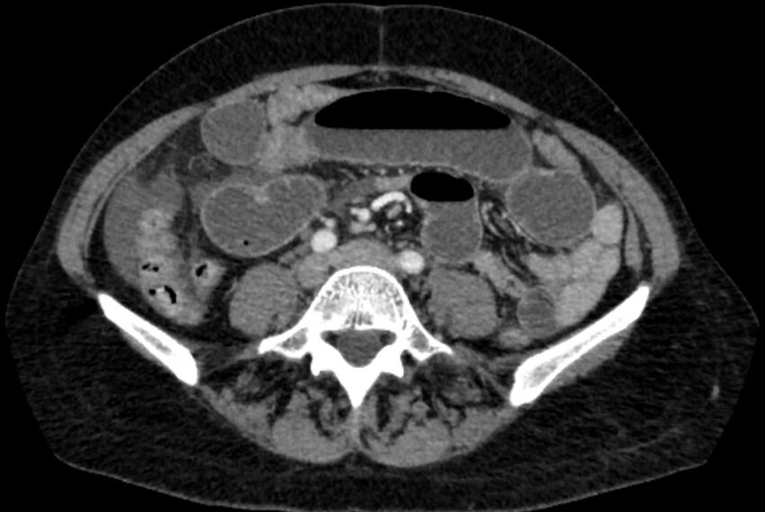 Closed loop small bowel obstruction (Radiopaedia 71211-81508 A 82).jpg