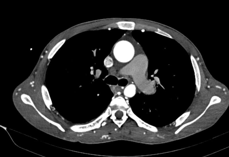 File:Coarctation of aorta with aortic valve stenosis (Radiopaedia 70463-80574 A 64).jpg