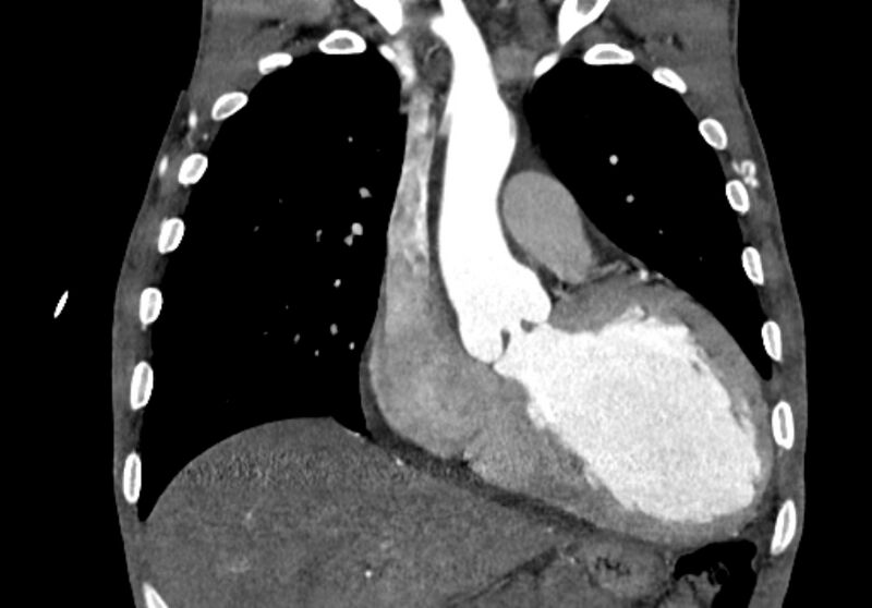 File:Coarctation of aorta with aortic valve stenosis (Radiopaedia 70463-80574 C 80).jpg