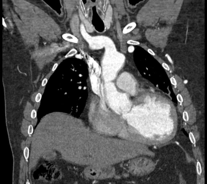 File:Coarctation of the aorta (Radiopaedia 53752-59822 B 29).jpg