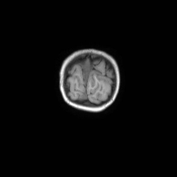 File:Cochlear nerve aplasia - unilateral (Radiopaedia 87910-104413 Coronal T1 52).jpg