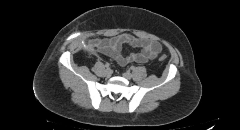 File:Colocutaneous fistula (Radiopaedia 56401-63062 Axial Fistulography 33).jpg