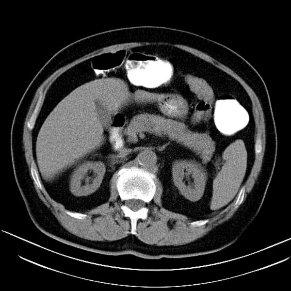 File:Colon adenocarcinoma (Radiopaedia 15157-15025 Axial non-contrast 1).jpg