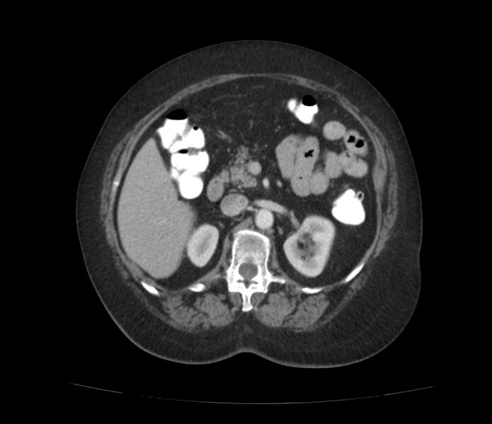 File:Colonic diverticulosis (Radiopaedia 22934-22957 A 25).jpg